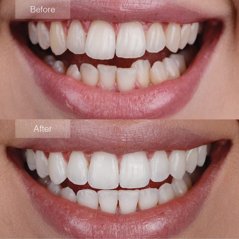 Invisalign at Novomed - Dubai Marina - dental clinic in Dubai Marina