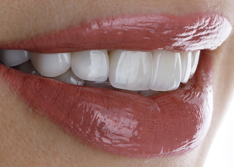 Veneers Dubai - Hollywood Smile - dental clinic in Umm Al Sheif